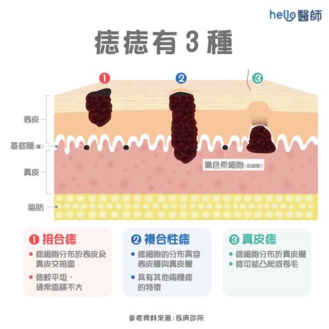 凸痣長毛|痣形成的原因？痣長毛、痣變多變大是痣病變？5招判。